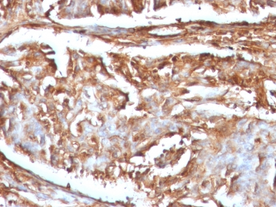 FFPE human renal cell carcinoma sections stained with 100 ul anti-Beta-2 Microglobulin (clone B2M/961) at 1:300. HIER epitope retrieval prior to staining was performed in 10mM Citrate, pH 6.0.